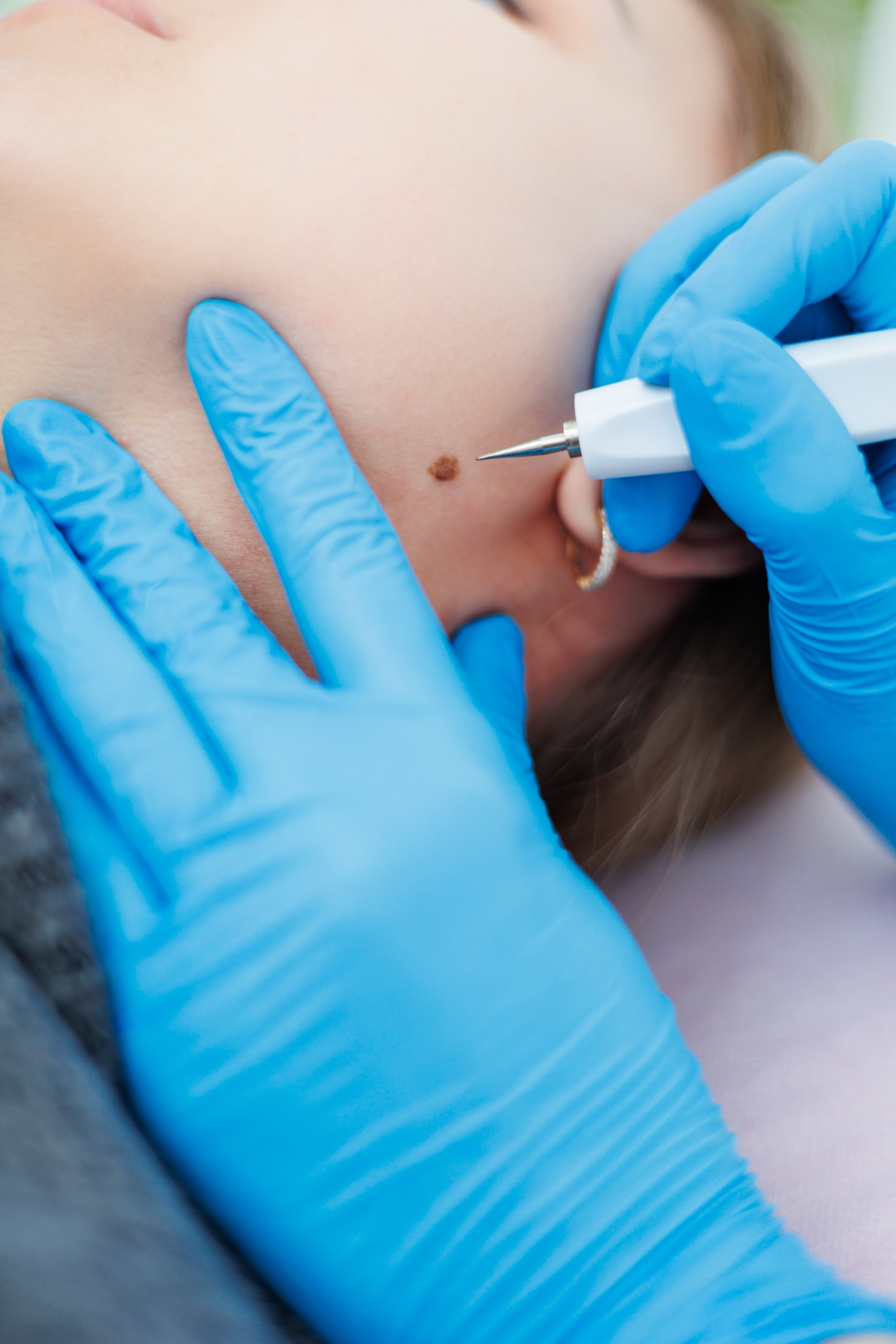 Warts and Mole Removal Image 3